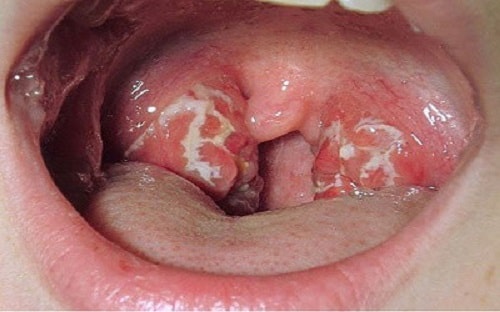 Biến chứng nguy hiểm từ bệnh lậu ở miệng