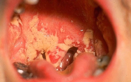 Triệu chứng bệnh lậu ở miệng xuất hiện như thế nào