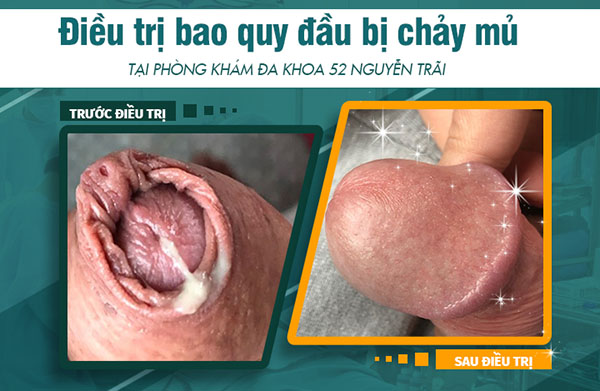 điều trị bao quy đầu chảy mủ