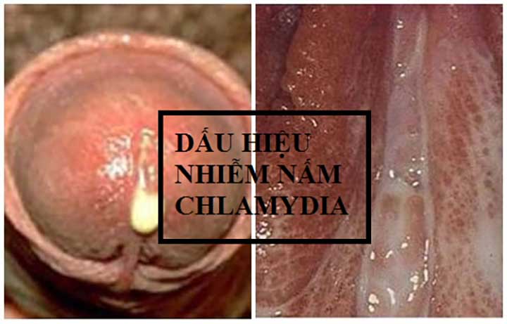 Bệnh chlamydia