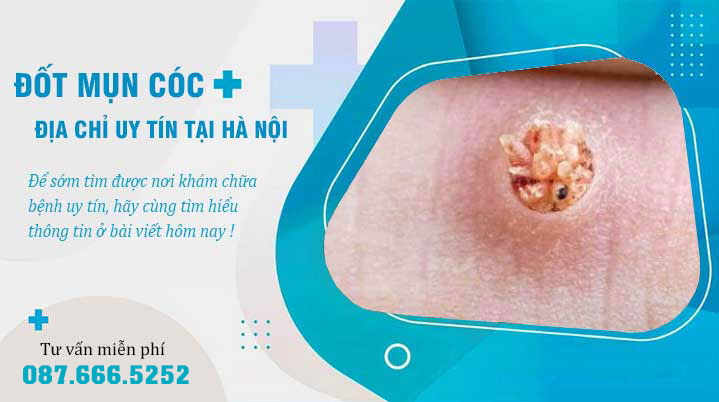 Đâu là địa chỉ đốt mụn cóc, mụn thịt uy tín tại Hà Nội?